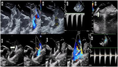 Stenting of critical aortic coarctation in neonates between 600 and 1,350 g. Using a transfemoral artery approach. A single center experience